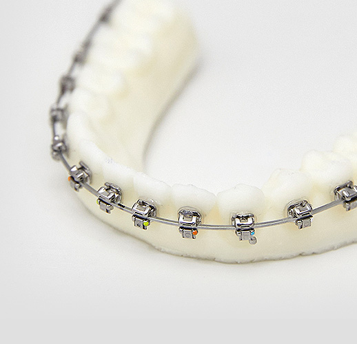 커스텀 교정치료