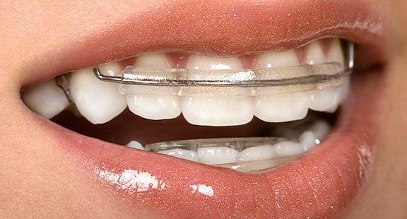 기능성 교정장치