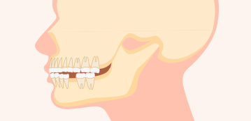 유치가 너무 빨리 빠진 경우