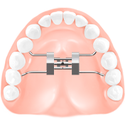 급속구개확장장치(MARPE, RPE)